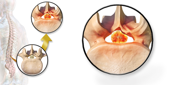 The Genetic Origins of Spinal Stenosis