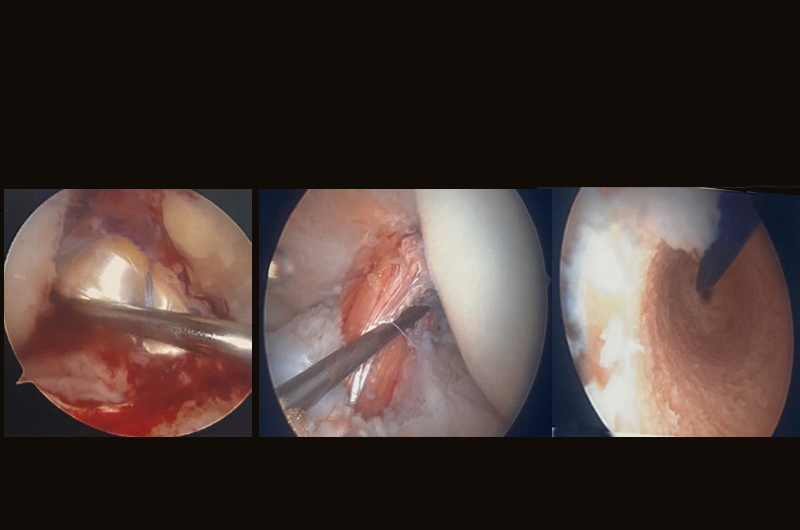 Anterior Cruciate Ligament (ACL) Reconstruction