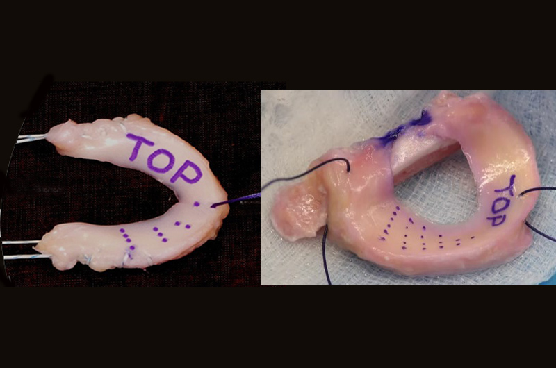 Meniscal Allograft Transplantation (MAT)