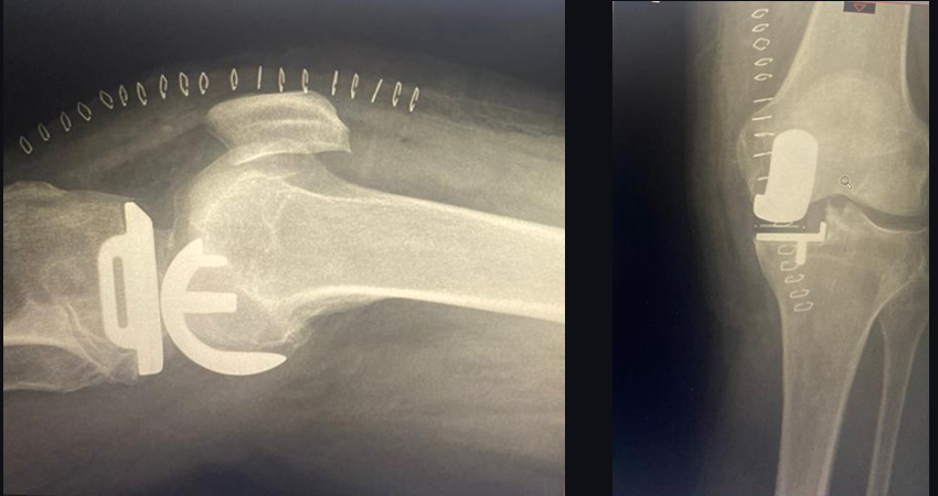 Total Knee Replacement