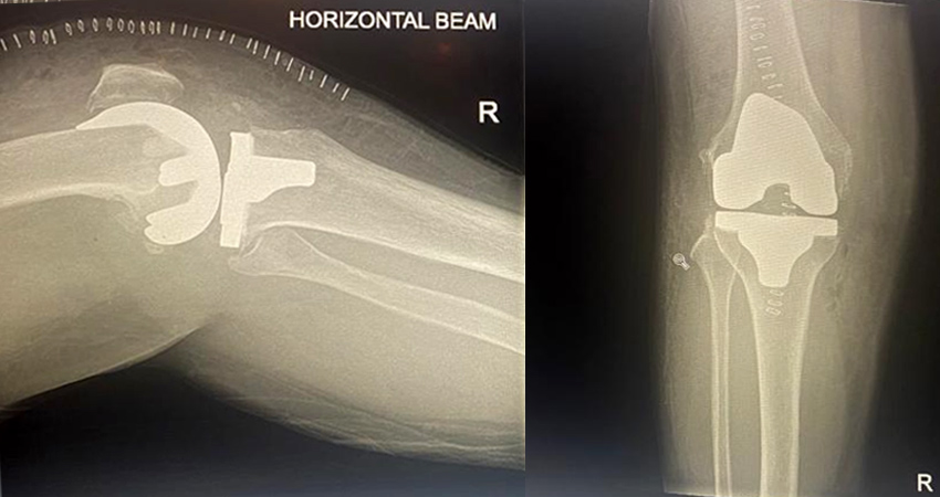 Total Knee Replacement